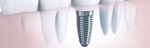 Dental Implant Complications