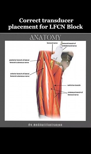 LFCN Block for Total Hip Surgery! #regionalanesthesia #nerveblock #totalhipreplacement