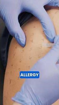 How do Allergy shots work?