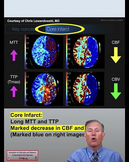 CT Perfusion Core Infarct & Ischemic Penumbra Findings: CTA & CTP Neuroimaging in Stroke Patients 26