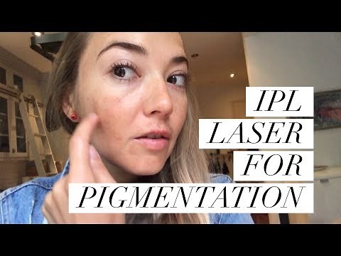 IPL LASER FOR PIGMENTATION | The Beauty Surfer | Dark Spots removal