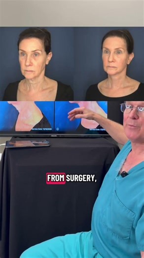 AWAKE Deep Plane Facelift Surgery with Dr. Claytor | Claytor Plastic Surgery