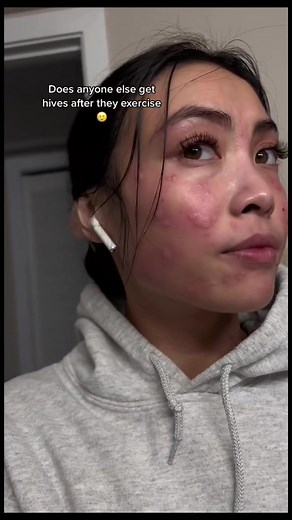 #stitch with @Cat 🏹🎨🎠📚 im using her as an example to eductae you 😄not necessarily her diagnosis #anaphylaxischeck #exercise #hives #csu #doctor #allergy #medicine