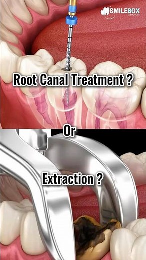 🦷 Root Canal or Extraction? Dr. Anond breaks it down! Don’t miss this expert advice!