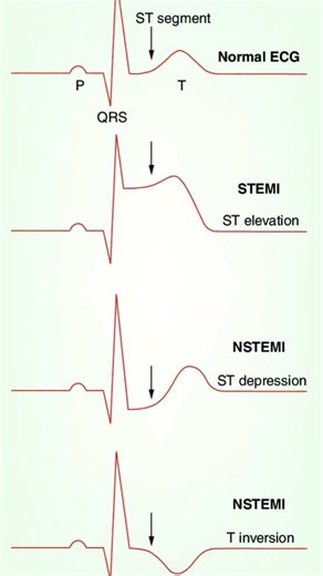 Ecg Territories on Instagram: "Normal ECG: Shows a typical P, QRS, and T wave pattern with an isoelectric (flat) ST segment. STEMI (ST-Elevation Myocardial Infarction): Characterized by an elevated ST segment, indicating a complete blockage of a coronary artery. NSTEMI (Non-ST-Elevation Myocardial Infarction): Characterized by an ST depression or T wave inversion, suggesting a partial blockage of a coronary artery. An ECG is a common, non-invasive diagnostic test used to measure the heart's elec