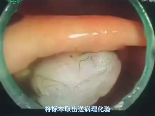 ESD手术过程简介及术后注意事项