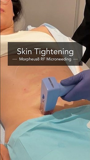 Morpheus8 for Abdomen Skin Tightening | Dr. Hooman Khorasani
