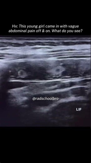 Comment sonographic finding? #ultrasound #sonography