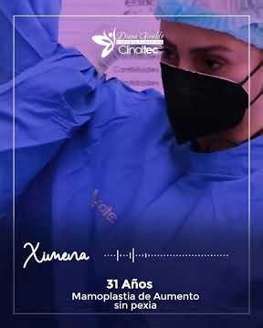 Mamoplastia de Aumento sin Pexia | La experiencia de una paciente