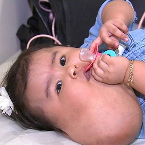 494K views · 12K reactions | This 1-year-old underwent an 8-hour surgery in NYC today to remove a large, rare growth on her neck. She will now have to learn how to eat and swallow -- and her parents hope she will soon be able to smile without suffering. Join us in sending well wishes to Sandy and her family for a quick recovery! | ABC7NY | Facebook