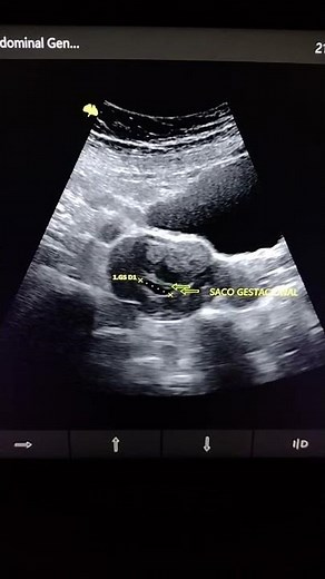 GESTATIONAL SAC OF 5 WEEKS OF GESTATION WITHOUT PRESENCE OF EMBRYO