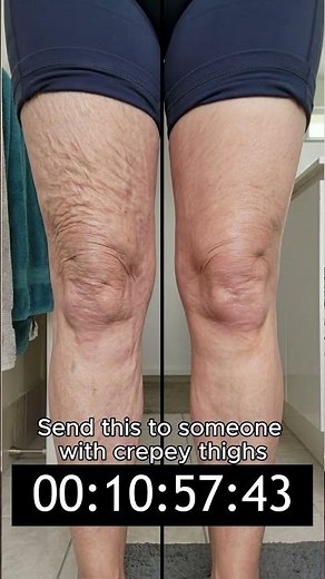 Crepey Thighs? Watch What Happens in Minutes 👀
