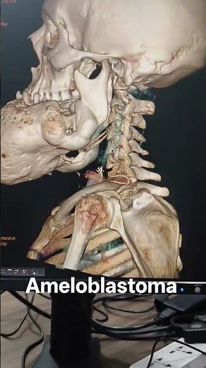 an ameloblastoma is a rare , slow growing and benign tumor that develops in jaw( likely mandible).