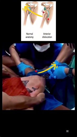 How to fix dislocated shoulder.