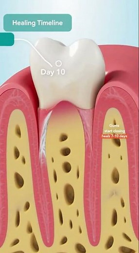 🦷 How Long Do Gums Take to Heal After a Tooth Extraction?