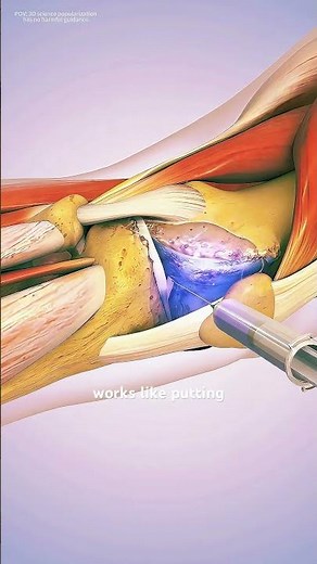 Visco Gel Injection For Treatment of Knee Osteoarthritis (3D animation) #cartilagedamage #cartilage