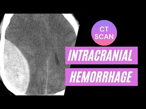 CT imaging of intracranial hemorrhage: For medical students, residents and clinicians.