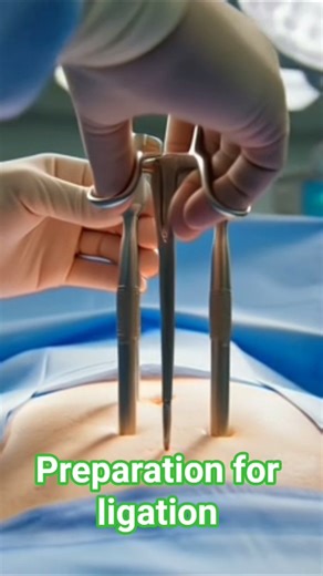 Preparation for ligation #health #surgery #appendix #leproscopy #viral #appendectomy #doctor