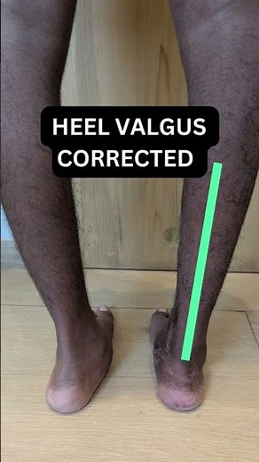 FLAT FOOT CORRECTION SURGERY 🦶✨