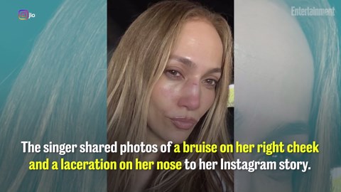 Jennifer Lopez injures her face during rehearsal for AMAs