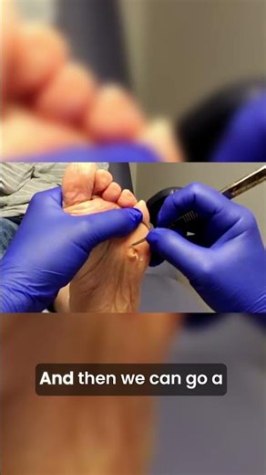 Follow-Up Care for Foot Comfort | I Had to STOP… This Callus Was Too Painful 😳
