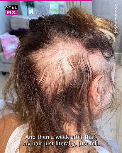 Beauty Beyond Hair: The Alopecia Model