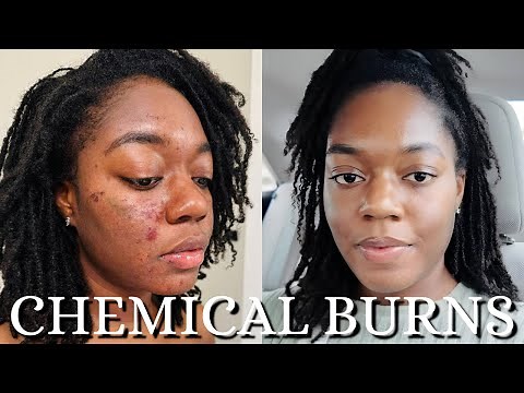 I RUINED my Skin! Fixing Chemical Burns, Scarring, and Dark Spots NOW