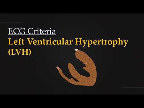 ECG Criteria for Left Ventricular Hypertrophy (LVH)
