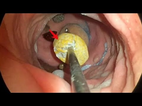 How Ureteric Stones Are Removed Endoscopically | URS Surgery Step by Step
