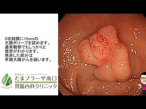 たまプラーザ南口胃腸内科クリニック～早期大腸がん 日帰り内視鏡治療 EMR～