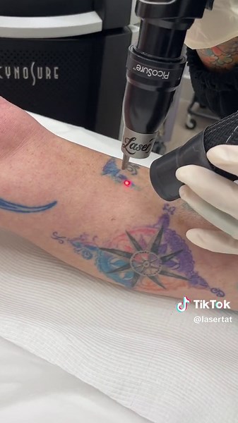 PicoSure Laser: Removing Blue and Green Hues for Safe Healing