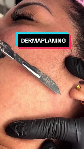 Dermaplaning: Cuidados para una Piel Radiante