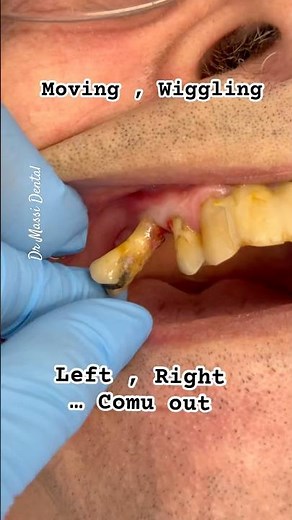 Wiggle wiggle tooth loose