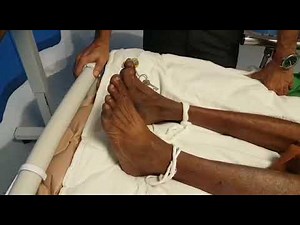 Elicitation of BABINSKI's Sign with Different Methods, Dept. Of Medicine, JNMC