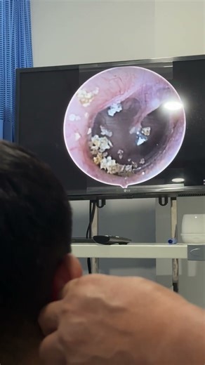 Unusual Find Inside 👂🔎 | Endoscope Reveals the Truth #Endoscopic #Doctor #Surprising