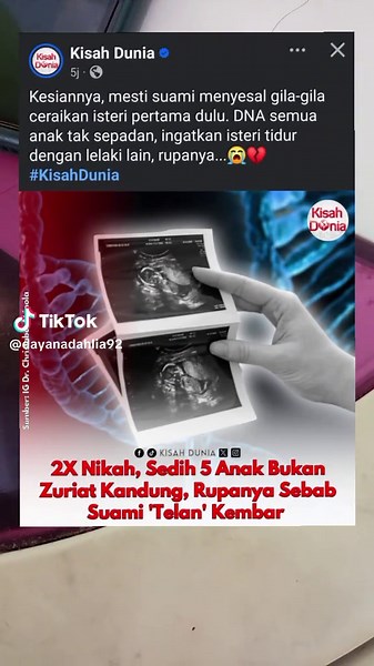 Understanding Chimera Twins: A Unique Medical Phenomenon