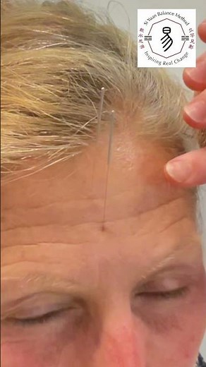Needling Demo , Balance method Acupuncture