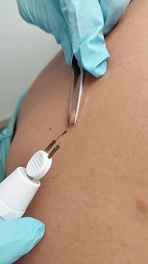 Giant Fibroma Removal #dermalclinician #huidtherapie #skincare #medicalcosmetic #skintags #fibromas #painfree #hospitallife #southamerica #nopain #fastandeasy