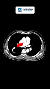 AI-Powered Pulmonary Embolism Detection | Precision Medical Image Annotation