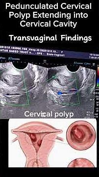 Ultrasound findings of cervical Polyp on TVS #ultrasound #health #medical #polyps @Dr.SaimaKhan
