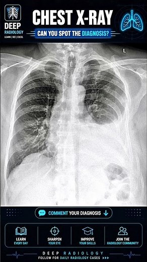 Flail Chest with Rib Fractures on X-ray #shorts
