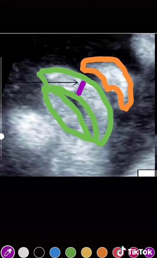 This is how cleft palate looks on ultrasound 😉#pregnancy #fetalultrasound #medical #medicine #cleftlip