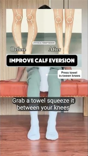 Bow Legs (Genu Varum) Correction 😳 | Real Results + Exercises #posture #gaittraining #trending