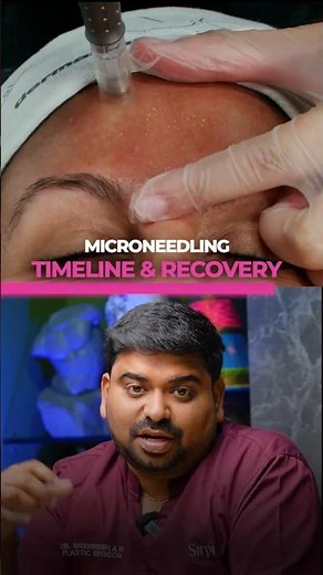 Microneedling Timeline Recovery