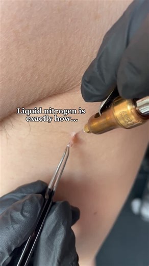 Specialist Skin Treatments | Acne | Laser | Aesthetics & Beauty on Instagram: "Liquid nitrogen is not talked about enough. 😍 We treat so many skin tags, warts, verrucas, sun spots with cryofreeze and the results are always insane. Look how easily we got rid of this skin tag- and no scarring was left!! Book a consultation for cryofreeze using the link in our profile."