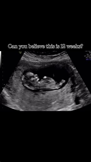 Can you believe this tiny human is just 12 weeks old? THIS is twelve weeks, lime-sized, fully formed major organs, little arms and legs already dancing around. At this stage, ultrasounds can capture those magical moments… mini kicks, stretches, little jumps, and that strong heartbeat that melts you on the spot. It’s incredible how much growth happens in just three months — the journey of life really starts so early. Did your 12-week scan surprise you too? Credit: @closetobaby #victoriassmileuk #