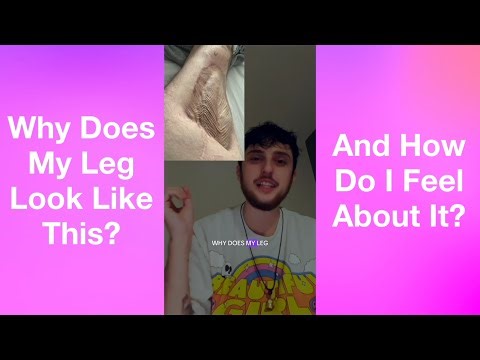 Why does my leg look like this? How I feel about my surgery/scar!