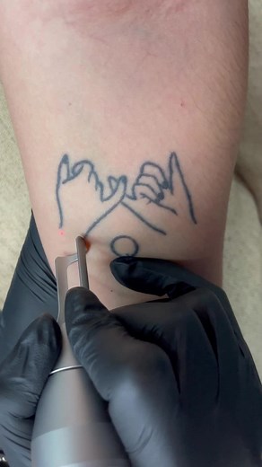 Effective Tattoo Removal Techniques with Laser Technology