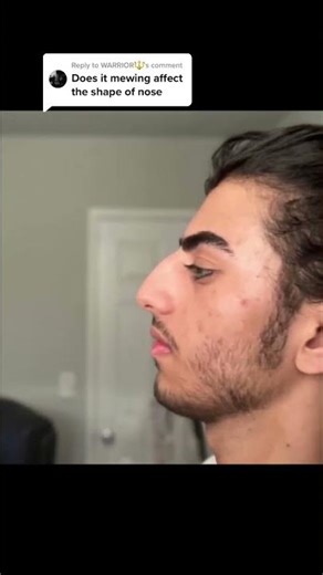 Can mewing change your nose shape?