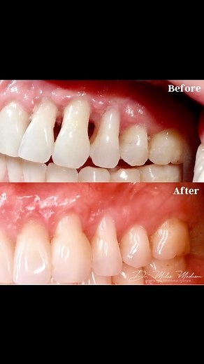 Dr. Miles Madison BeverlyHills on Instagram: "Severe gingival recession and black triangles treated with combination of gum grafting surgery and Bioclear composite restorations. I saw the patient a few months ago and the results are still holding up now 5 years post treatment. #gumgraft #periodoncia #blacktriangles #periodontist"